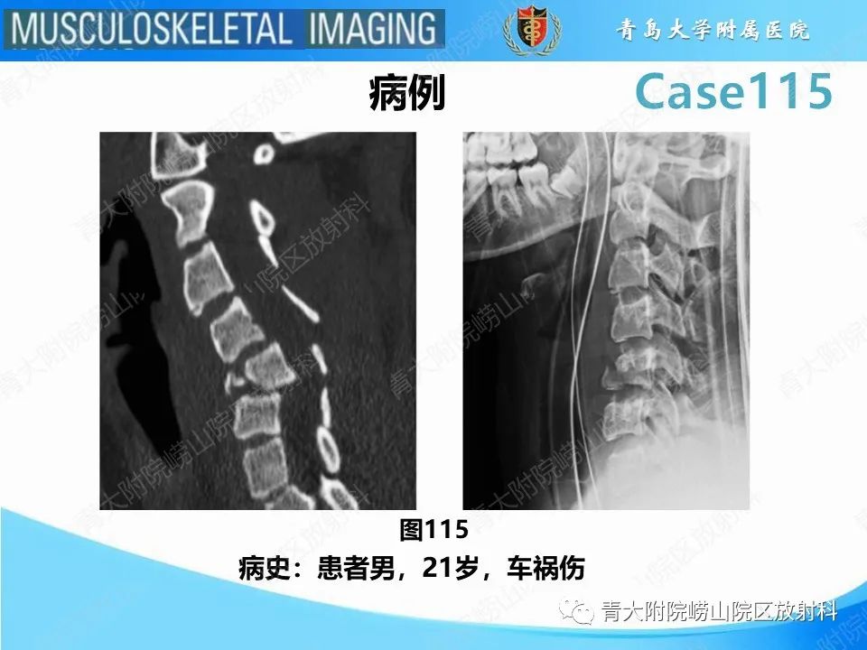 影像PPT - 【PPT】屈曲泪滴型骨折-2