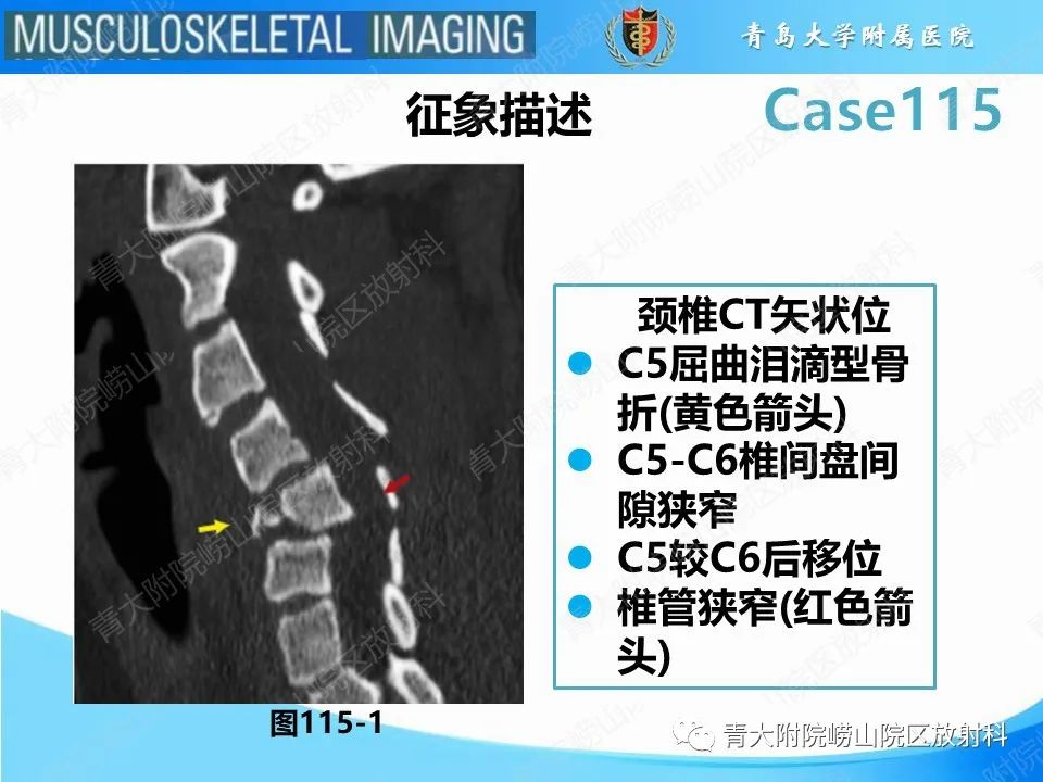 影像PPT - 【PPT】屈曲泪滴型骨折-11