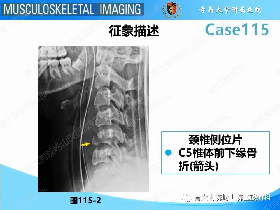 影像PPT - 【PPT】屈曲泪滴型骨折-12