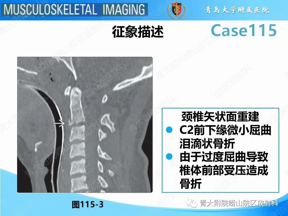 影像PPT - 【PPT】屈曲泪滴型骨折-13