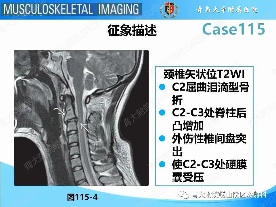 影像PPT - 【PPT】屈曲泪滴型骨折-14