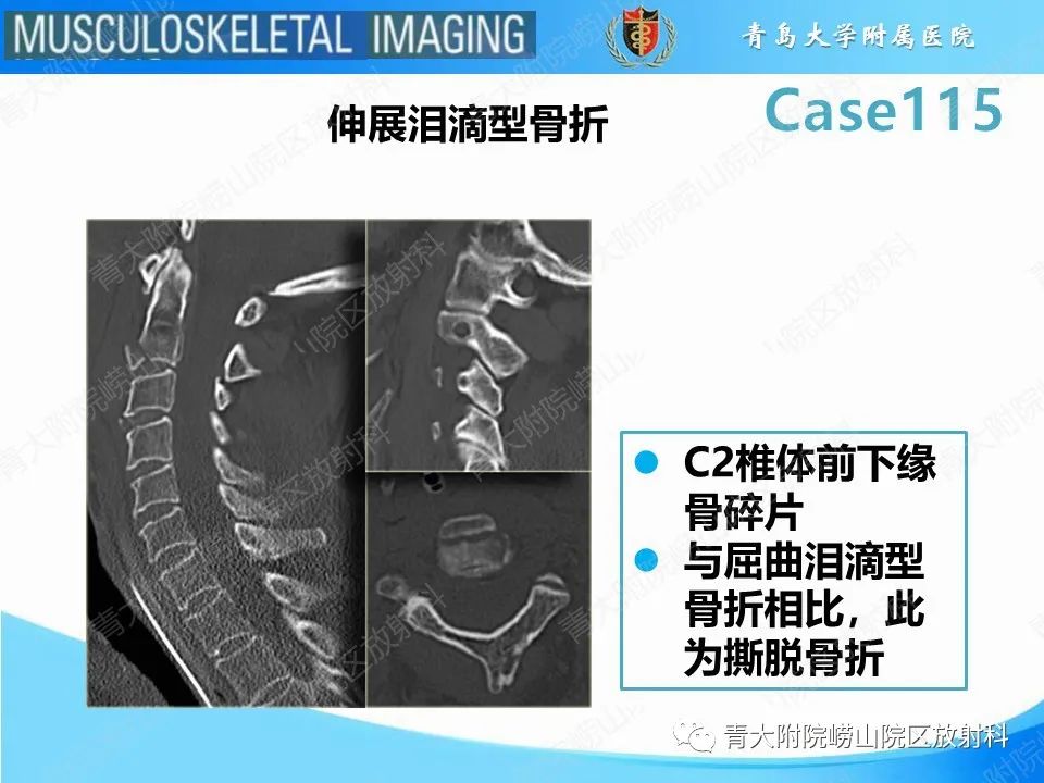 影像PPT - 【PPT】屈曲泪滴型骨折-17