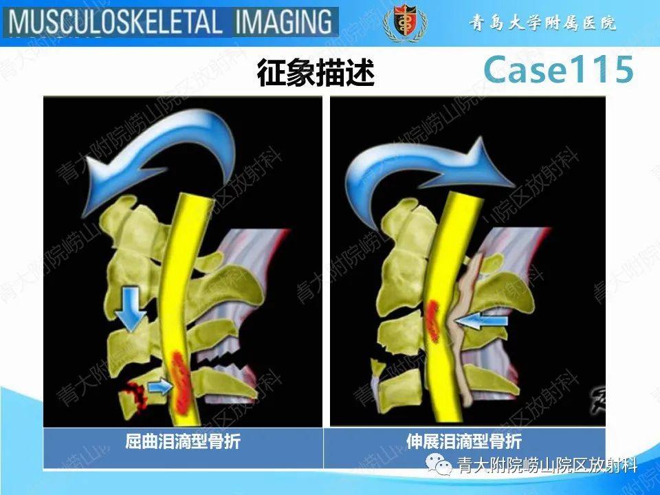 影像PPT - 【PPT】屈曲泪滴型骨折-15