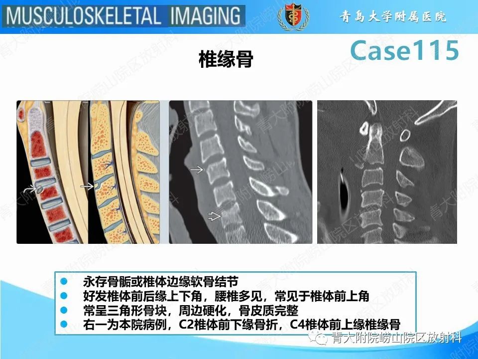 影像PPT - 【PPT】屈曲泪滴型骨折-19