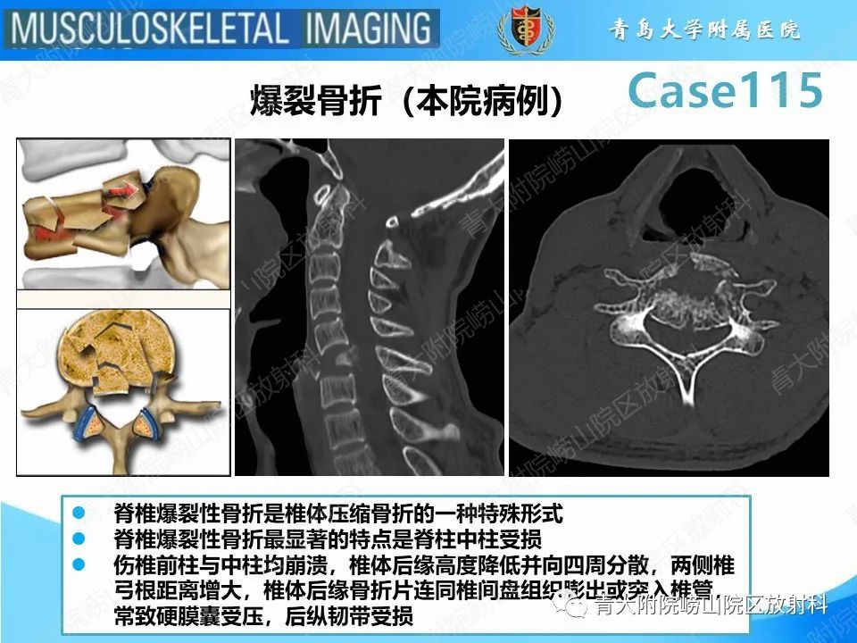 影像PPT - 【PPT】屈曲泪滴型骨折-20