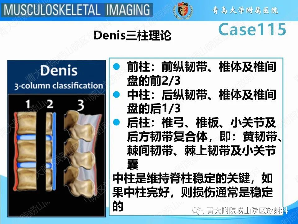 影像PPT - 【PPT】屈曲泪滴型骨折-21