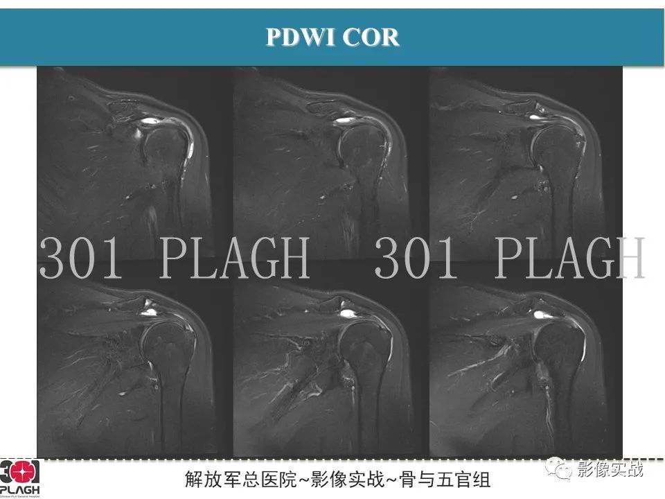 影像PPT - 【PPT】肩峰下撞击综合征-1