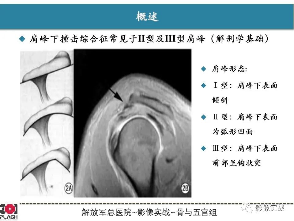 影像PPT - 【PPT】肩峰下撞击综合征-4