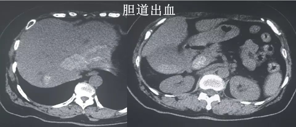 影像PPT - 【病例】头孢曲松钠致胆囊假性结石2例CT影像-8 影像PPT - 【病例】头孢曲松钠致胆囊假性结石2例CT影像-8