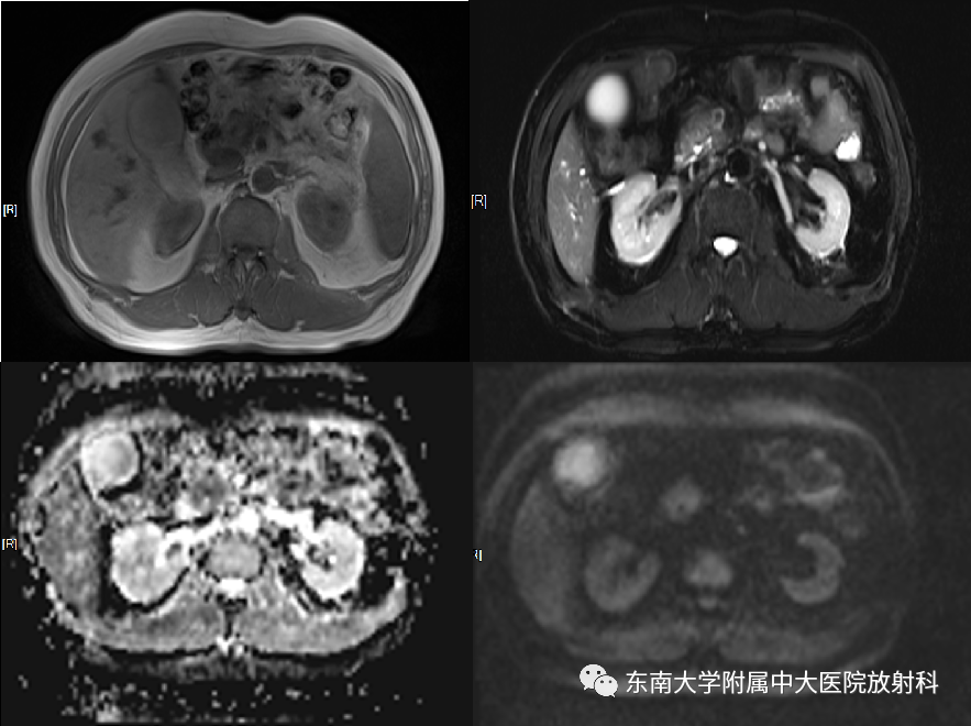 影像PPT - 【PPT】胰腺癌影像诊断及鉴别诊断-2