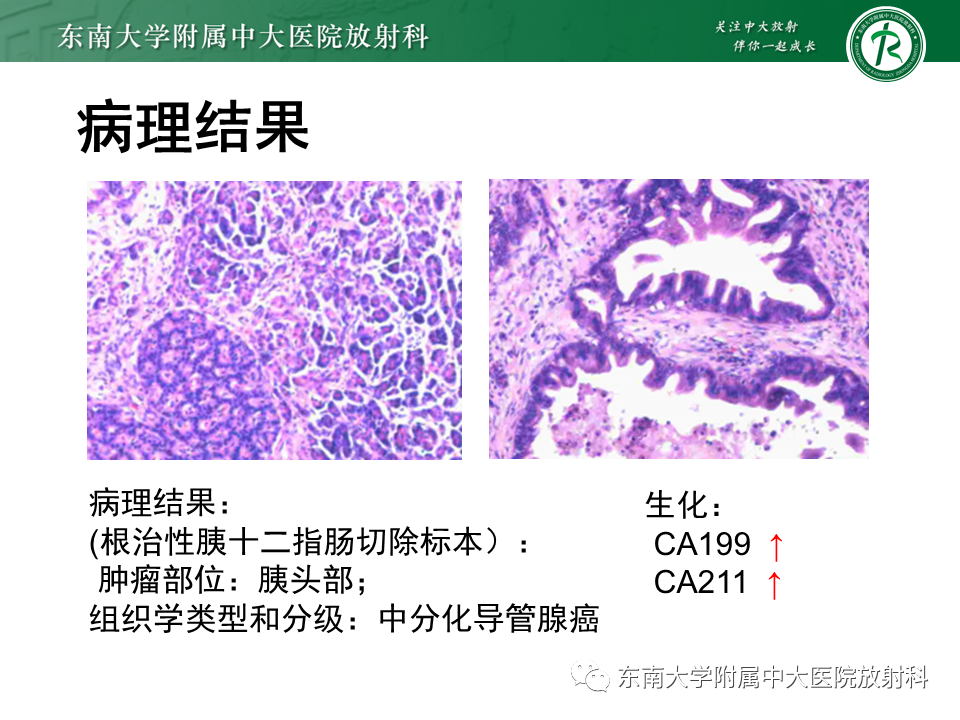 影像PPT - 【PPT】胰腺癌影像诊断及鉴别诊断-3