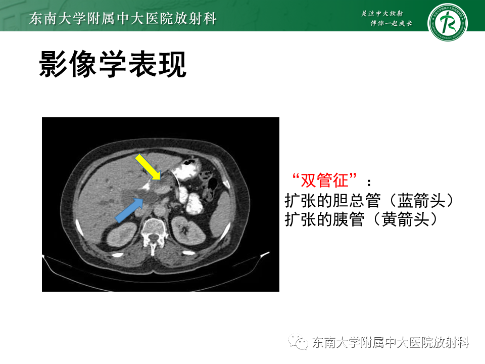影像PPT - 【PPT】胰腺癌影像诊断及鉴别诊断-11