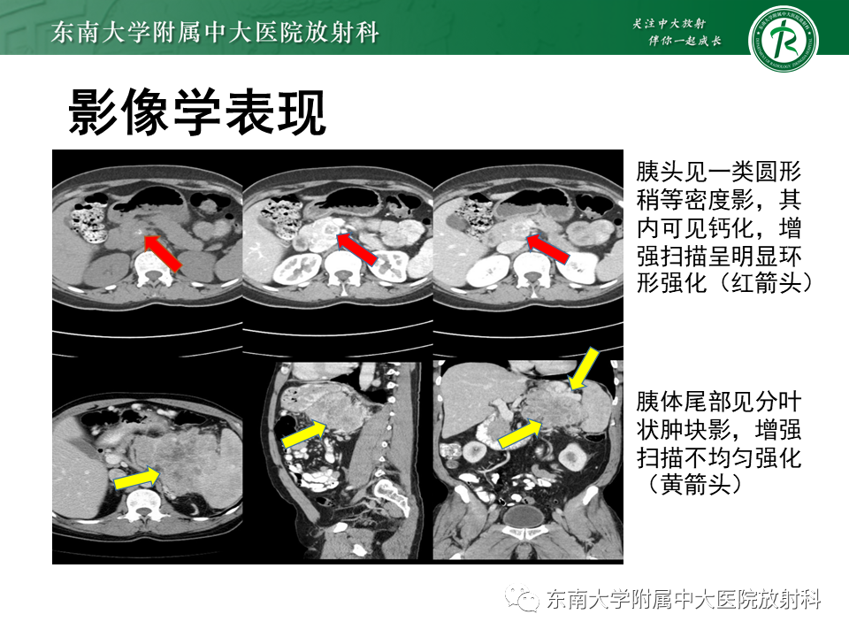 影像PPT - 【PPT】胰腺癌影像诊断及鉴别诊断-13