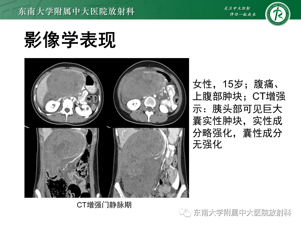 影像PPT - 【PPT】胰腺癌影像诊断及鉴别诊断-16
