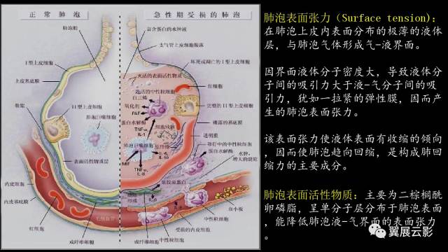 影像PPT - 【PPT】急性呼吸窘迫综合征-9