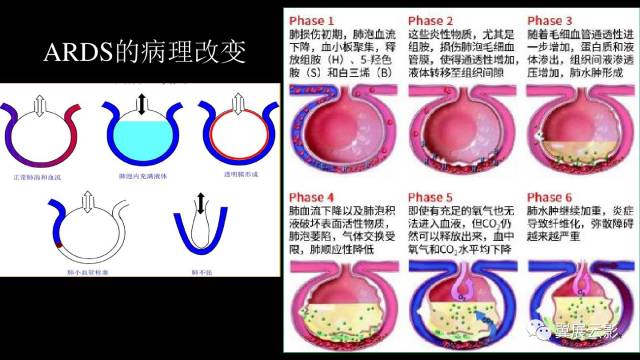 影像PPT - 【PPT】急性呼吸窘迫综合征-10