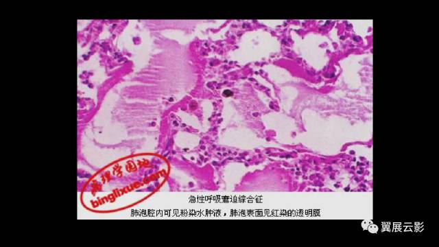 影像PPT - 【PPT】急性呼吸窘迫综合征-13