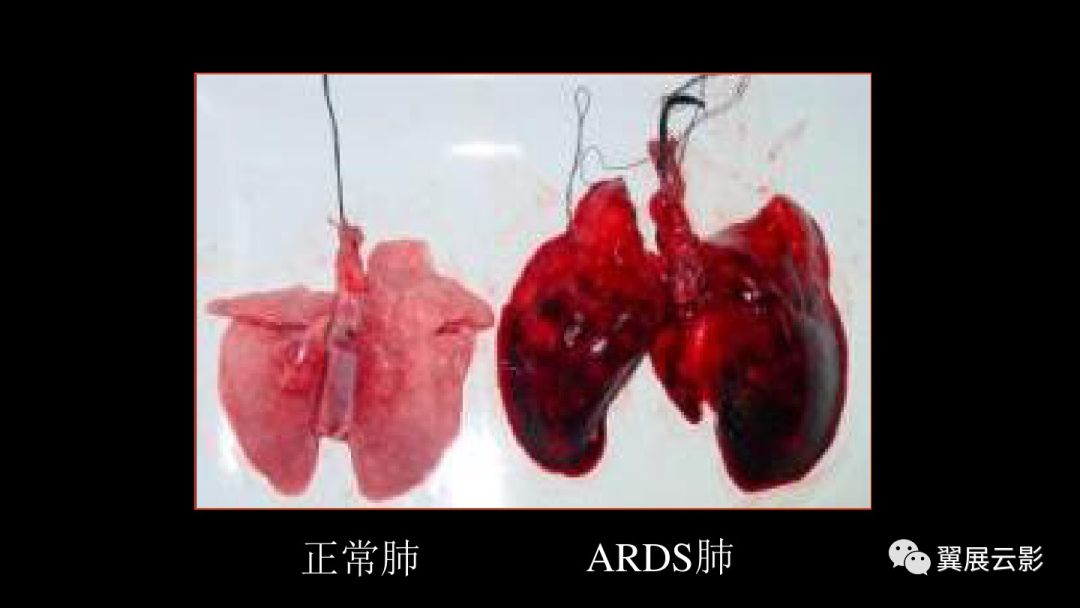 影像PPT - 【PPT】急性呼吸窘迫综合征-14