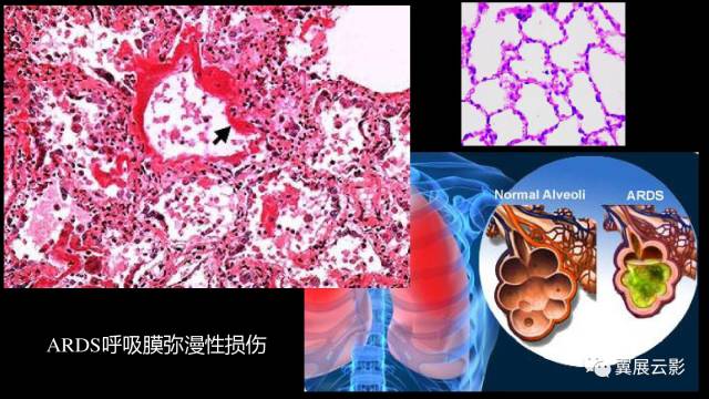 影像PPT - 【PPT】急性呼吸窘迫综合征-12
