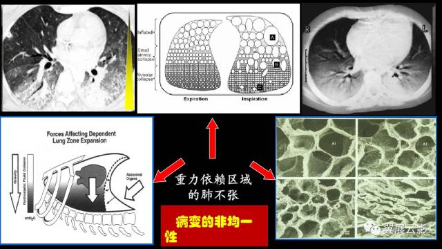 影像PPT - 【PPT】急性呼吸窘迫综合征-23