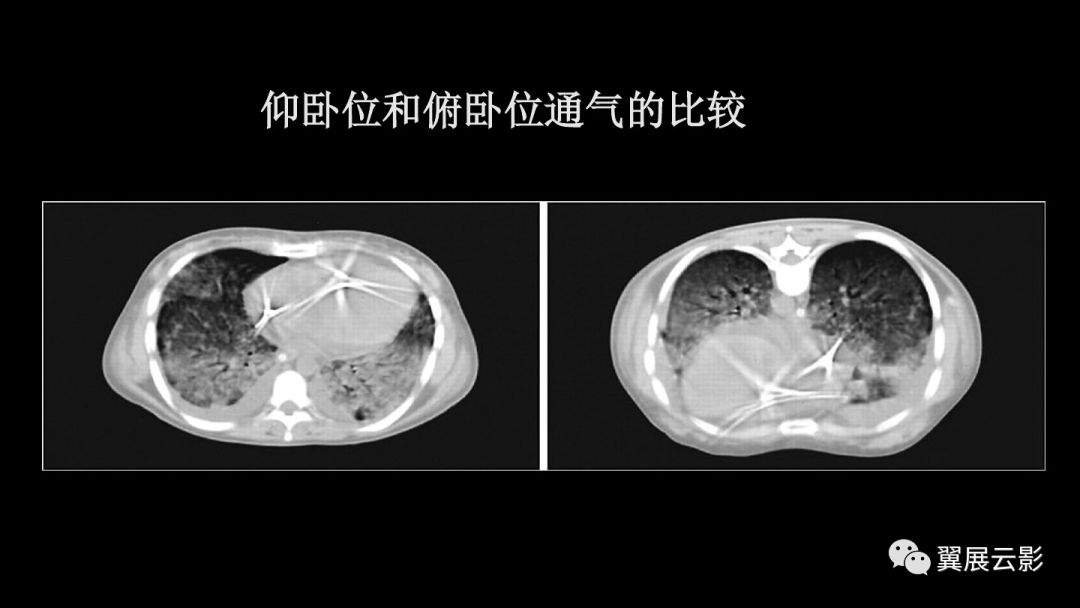 影像PPT - 【PPT】急性呼吸窘迫综合征-24