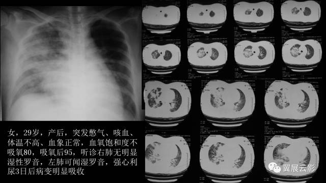 影像PPT - 【PPT】急性呼吸窘迫综合征-32