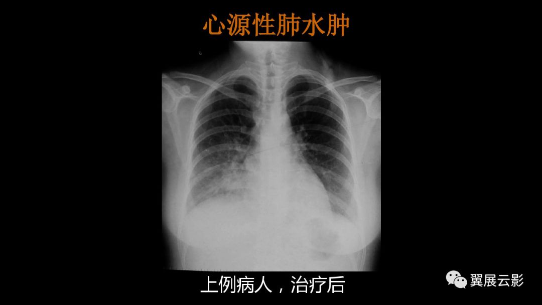 影像PPT - 【PPT】急性呼吸窘迫综合征-33