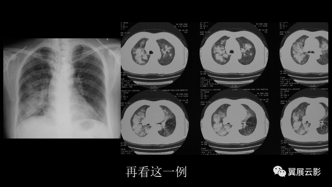 影像PPT - 【PPT】急性呼吸窘迫综合征-34