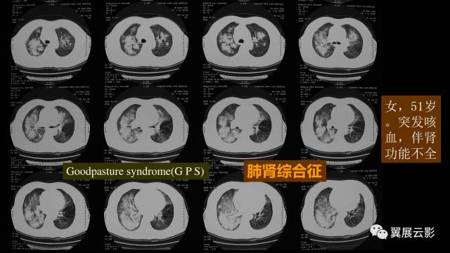 影像PPT - 【PPT】急性呼吸窘迫综合征-35
