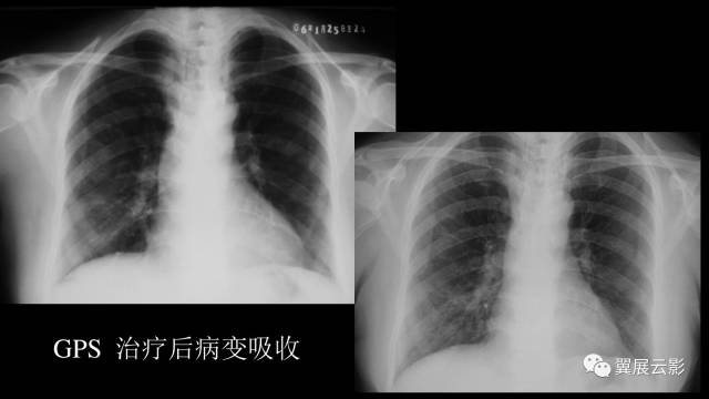 影像PPT - 【PPT】急性呼吸窘迫综合征-36