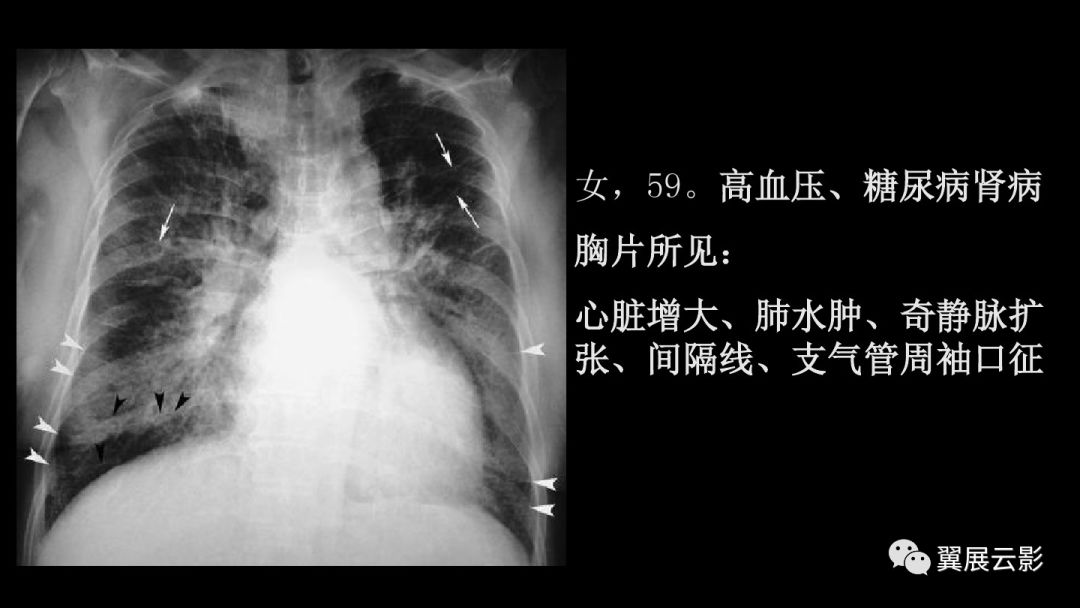 影像PPT - 【PPT】急性呼吸窘迫综合征-37