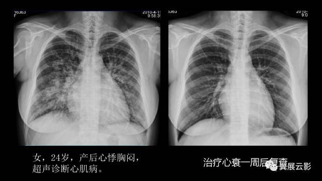 影像PPT - 【PPT】急性呼吸窘迫综合征-38