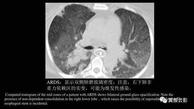 影像PPT - 【PPT】急性呼吸窘迫综合征-41