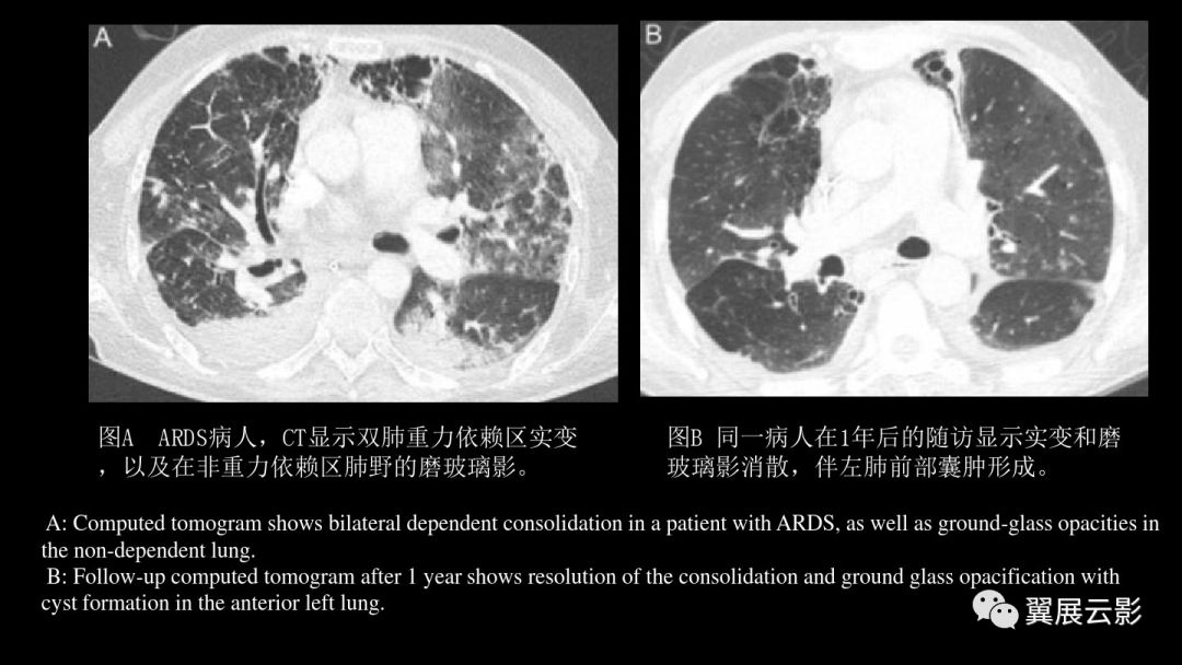 影像PPT - 【PPT】急性呼吸窘迫综合征-42