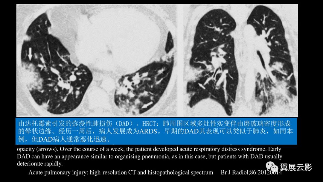 影像PPT - 【PPT】急性呼吸窘迫综合征-44