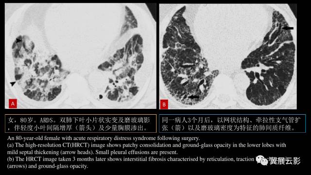 影像PPT - 【PPT】急性呼吸窘迫综合征-46