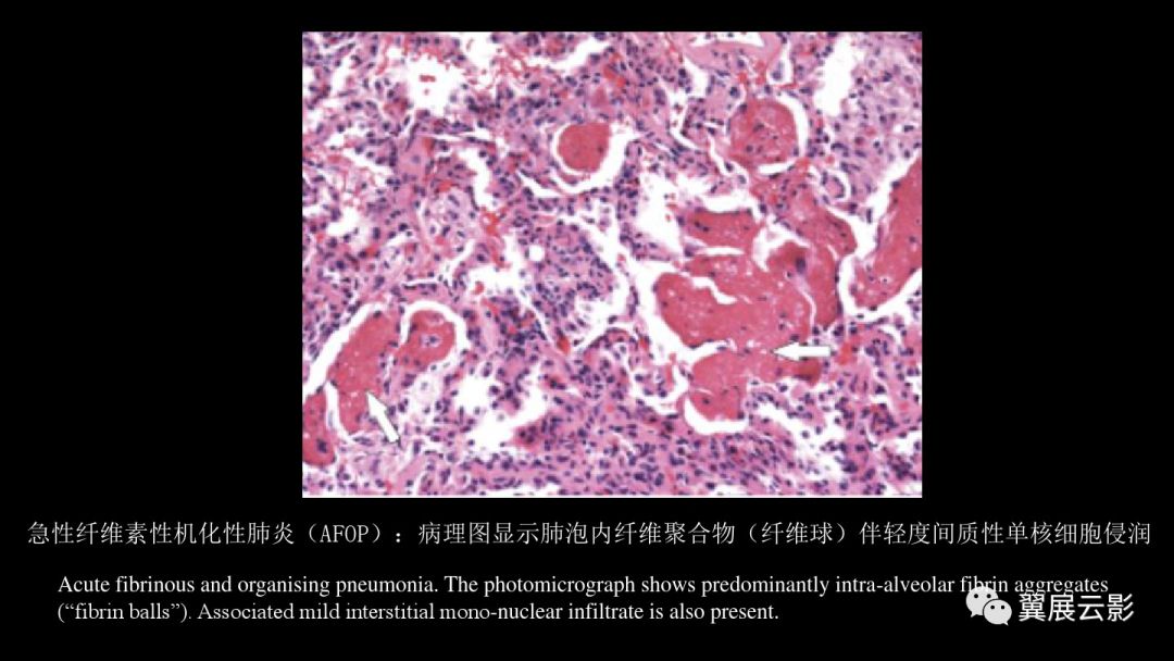 影像PPT - 【PPT】急性呼吸窘迫综合征-47