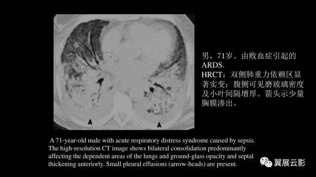 影像PPT - 【PPT】急性呼吸窘迫综合征-45