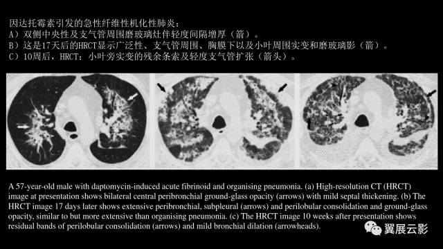 影像PPT - 【PPT】急性呼吸窘迫综合征-48