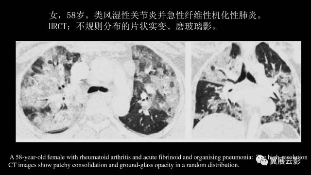 影像PPT - 【PPT】急性呼吸窘迫综合征-49