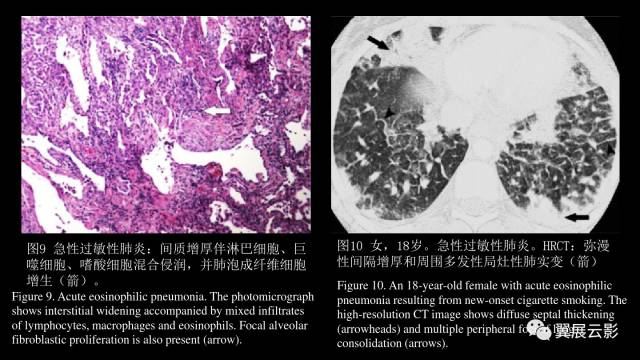 影像PPT - 【PPT】急性呼吸窘迫综合征-50