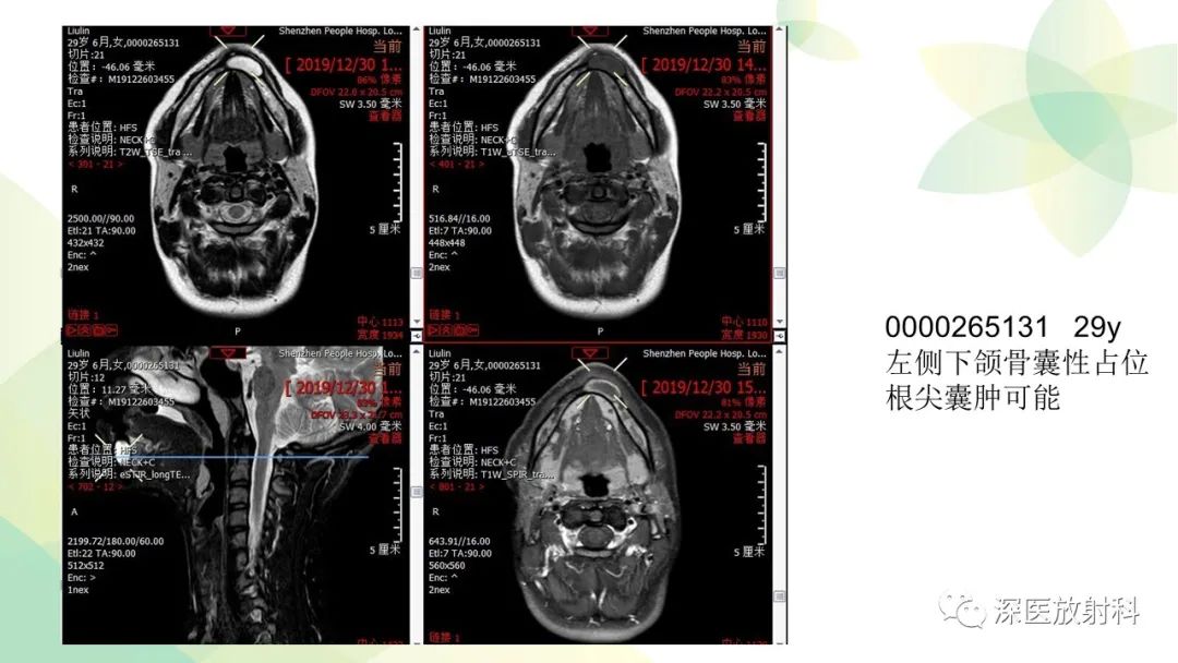 影像PPT - 【PPT】颌骨病变的影像表现-11
