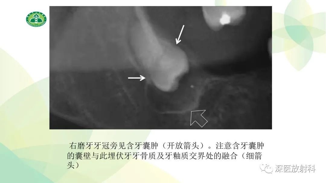 影像PPT - 【PPT】颌骨病变的影像表现-13