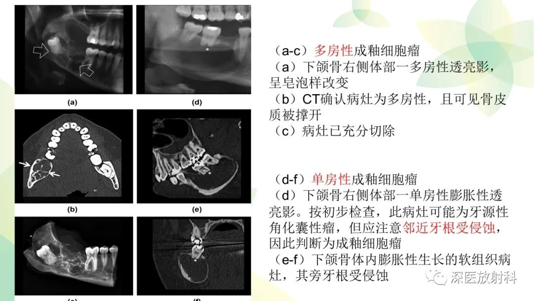影像PPT - 【PPT】颌骨病变的影像表现-19