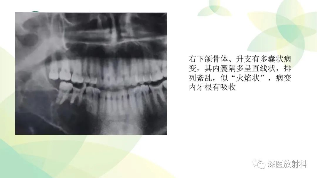 影像PPT - 【PPT】颌骨病变的影像表现-24