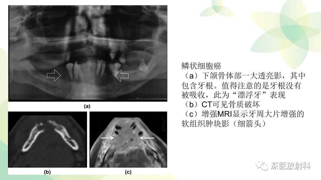 影像PPT - 【PPT】颌骨病变的影像表现-28