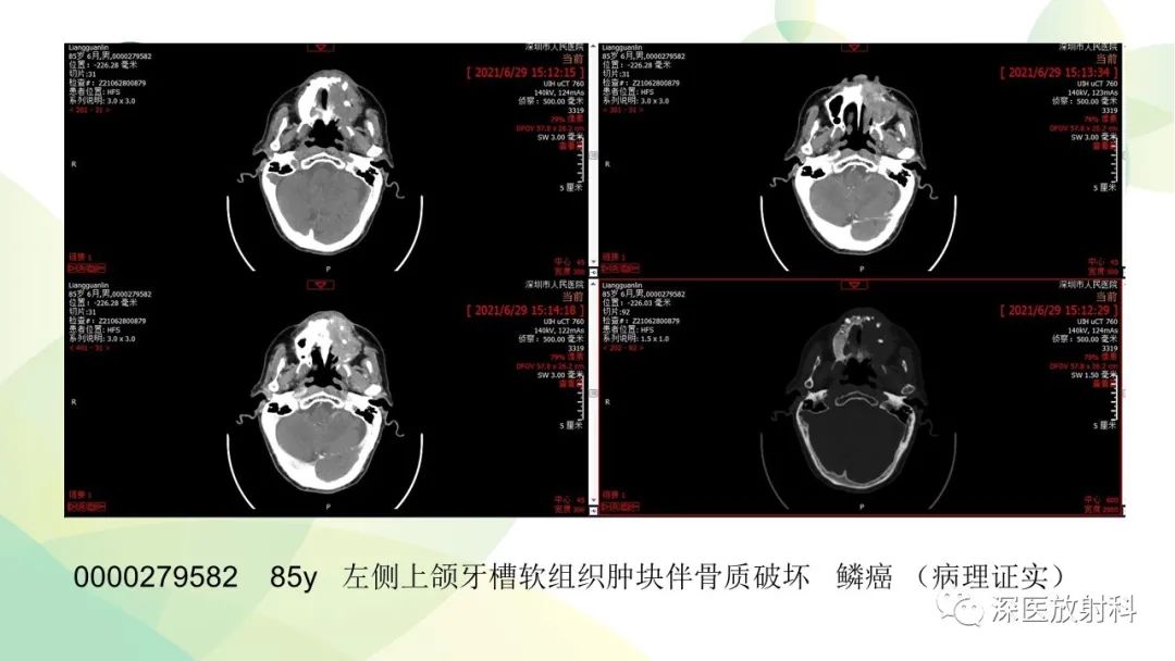 影像PPT - 【PPT】颌骨病变的影像表现-29