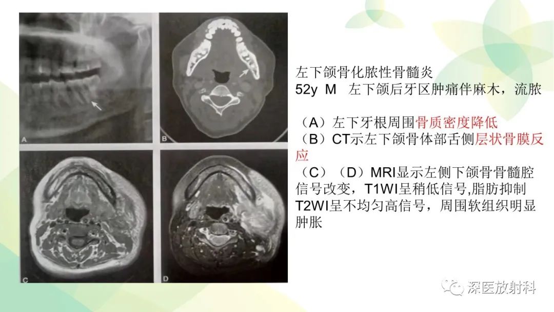 影像PPT - 【PPT】颌骨病变的影像表现-31