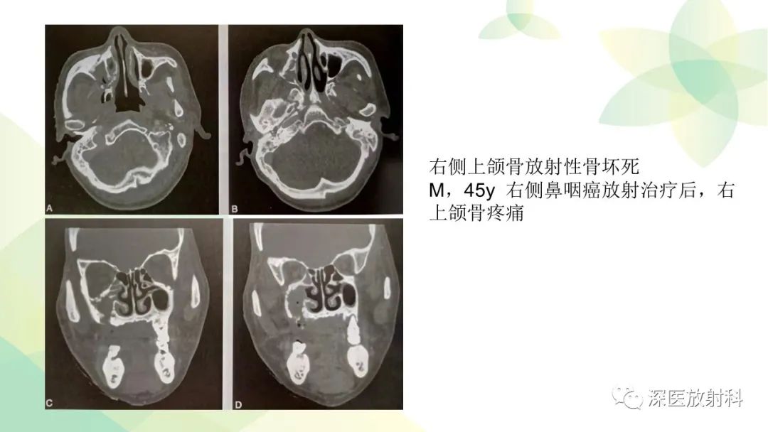 影像PPT - 【PPT】颌骨病变的影像表现-33