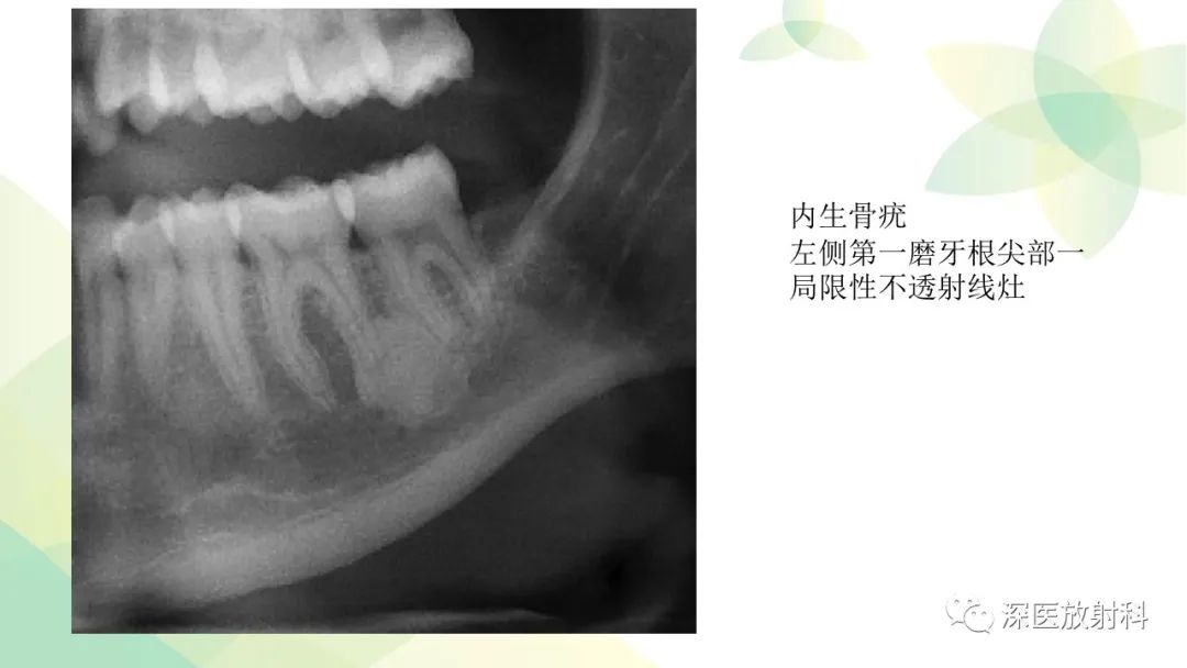 影像PPT - 【PPT】颌骨病变的影像表现-36